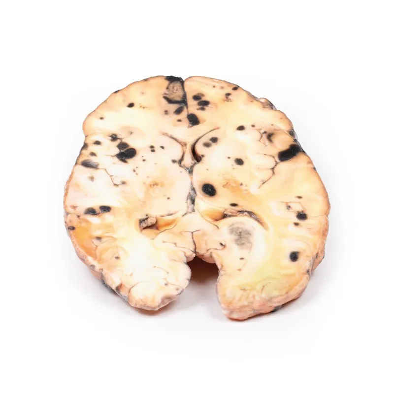 3D Printed Metastatic Melanoma