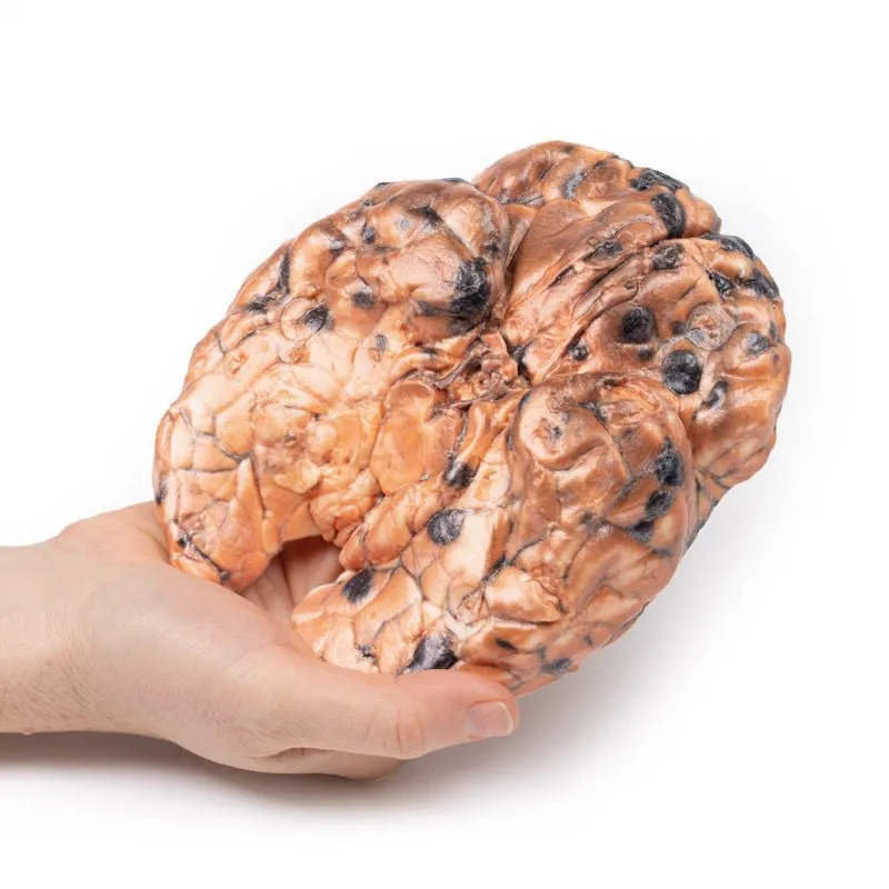 3D Printed Metastatic Melanoma