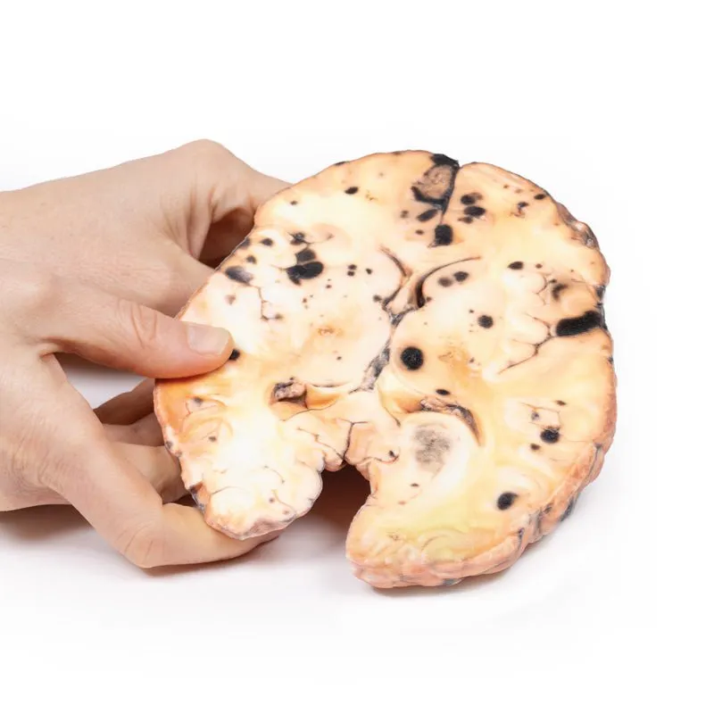 3D Printed Metastatic Melanoma